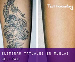 Eliminar tatuajes en Muelas del Pan