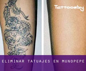 Eliminar tatuajes en Muñopepe