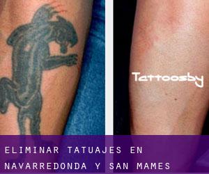 Eliminar tatuajes en Navarredonda y San Mamés