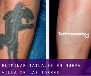 Eliminar tatuajes en Nueva Villa de las Torres