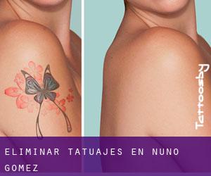 Eliminar tatuajes en Nuño Gómez