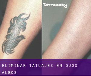 Eliminar tatuajes en Ojos-Albos
