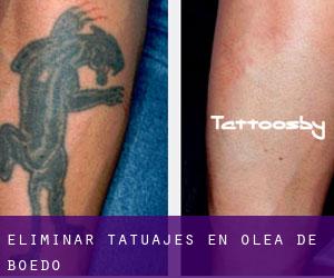 Eliminar tatuajes en Olea de Boedo