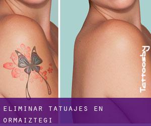 Eliminar tatuajes en Ormaiztegi