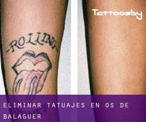 Eliminar tatuajes en Os de Balaguer