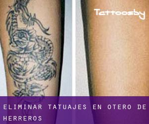 Eliminar tatuajes en Otero de Herreros