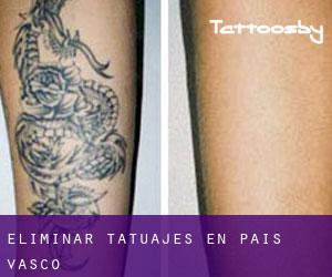 Eliminar tatuajes en País Vasco