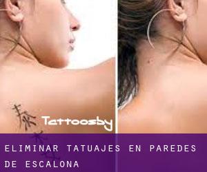 Eliminar tatuajes en Paredes de Escalona
