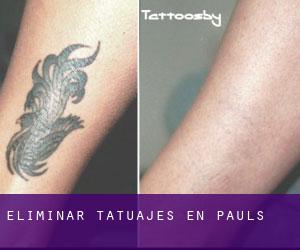 Eliminar tatuajes en Paüls