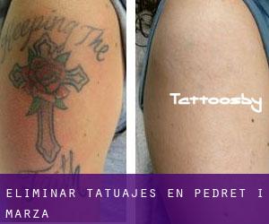 Eliminar tatuajes en Pedret i Marzà