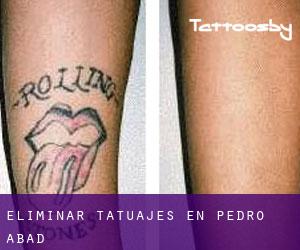 Eliminar tatuajes en Pedro Abad