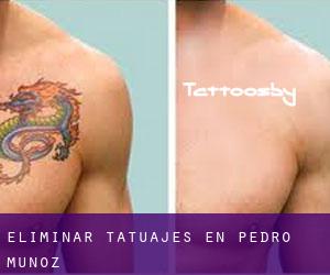 Eliminar tatuajes en Pedro Muñoz