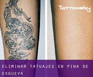 Eliminar tatuajes en Piña de Esgueva