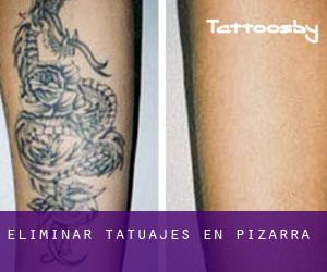 Eliminar tatuajes en Pizarra