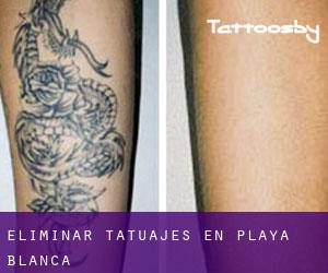 Eliminar tatuajes en Playa Blanca