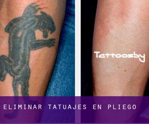 Eliminar tatuajes en Pliego