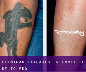 Eliminar tatuajes en Portillo de Toledo