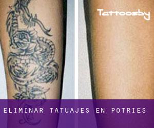 Eliminar tatuajes en Potríes