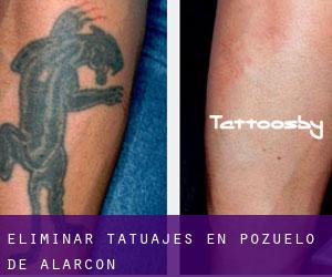 Eliminar tatuajes en Pozuelo de Alarcón