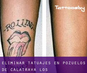 Eliminar tatuajes en Pozuelos de Calatrava (Los)