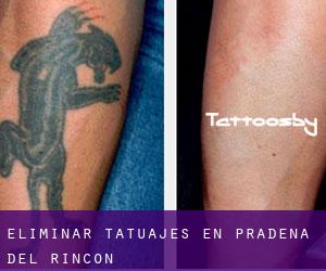 Eliminar tatuajes en Prádena del Rincón
