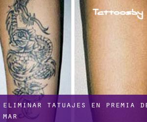 Eliminar tatuajes en Premià de Mar