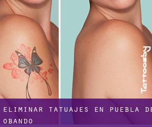 Eliminar tatuajes en Puebla de Obando