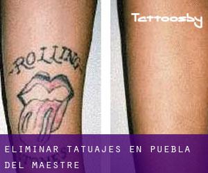 Eliminar tatuajes en Puebla del Maestre