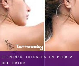 Eliminar tatuajes en Puebla del Prior
