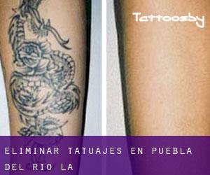 Eliminar tatuajes en Puebla del Río (La)