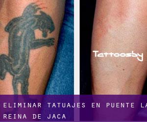 Eliminar tatuajes en Puente la Reina de Jaca