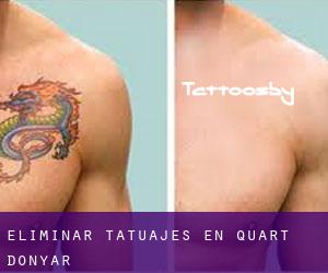 Eliminar tatuajes en Quart d'Onyar