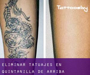 Eliminar tatuajes en Quintanilla de Arriba