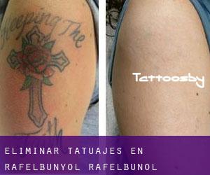 Eliminar tatuajes en Rafelbunyol / Rafelbuñol
