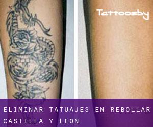 Eliminar tatuajes en Rebollar (Castilla y León)