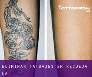 Eliminar tatuajes en Recueja (La)