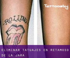 Eliminar tatuajes en Retamoso de la Jara