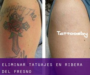 Eliminar tatuajes en Ribera del Fresno
