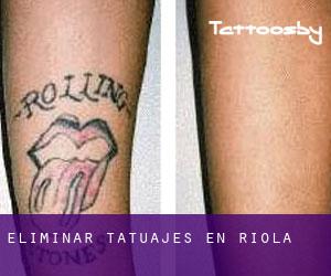 Eliminar tatuajes en Riola