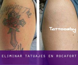 Eliminar tatuajes en Rocafort