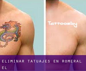 Eliminar tatuajes en Romeral (El)