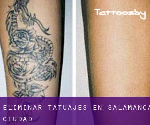 Eliminar tatuajes en Salamanca (Ciudad)