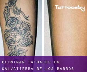 Eliminar tatuajes en Salvatierra de los Barros