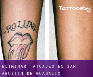 Eliminar tatuajes en San Agustín de Guadalix
