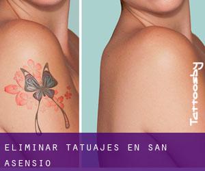 Eliminar tatuajes en San Asensio
