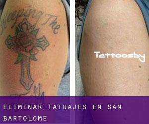 Eliminar tatuajes en San Bartolomé