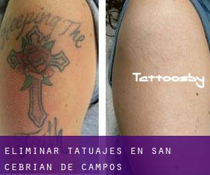 Eliminar tatuajes en San Cebrián de Campos