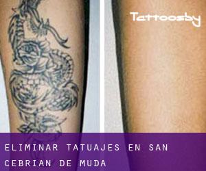 Eliminar tatuajes en San Cebrián de Mudá
