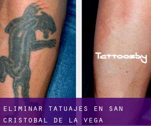 Eliminar tatuajes en San Cristóbal de la Vega