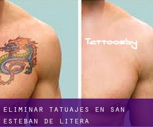 Eliminar tatuajes en San Esteban de Litera